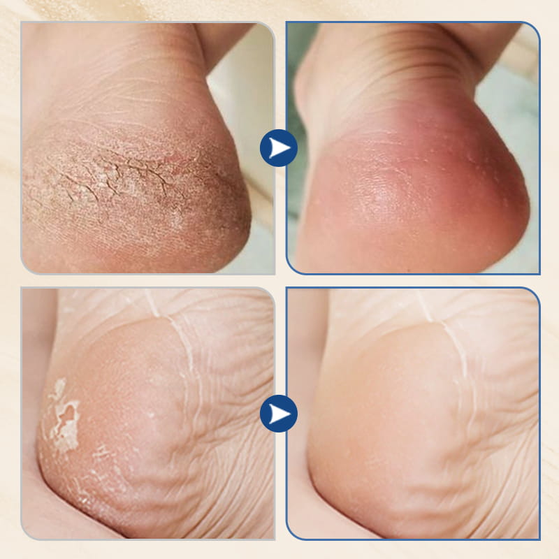 🎉Buy 2 Get 1 Free🎉Hydrating and Anti-Cracking Foot Cream