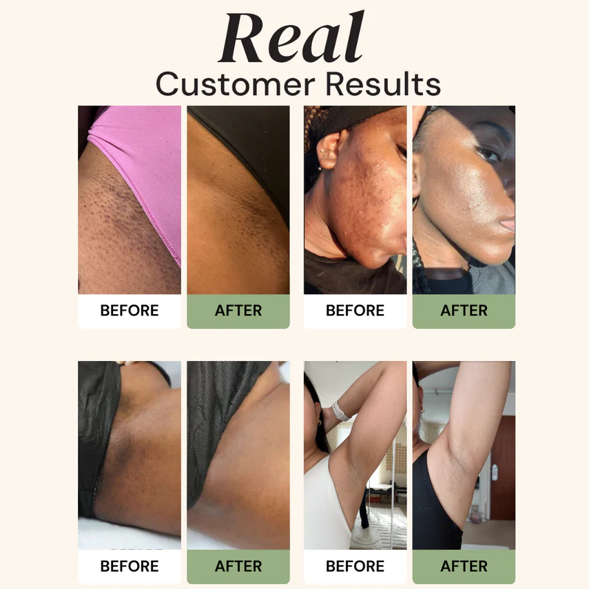 🔥Limited Time Special Price !!🎉CuraGlow Anti-Spots & Hyperpigmentation Soap