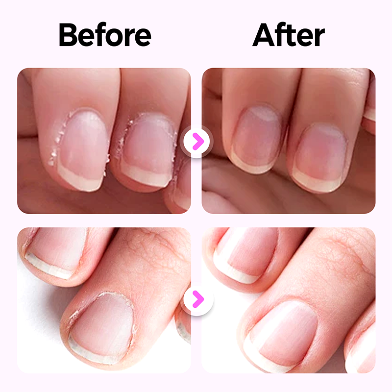 💜Christmas Sale 50% OFF💜2025 New Upgraded 3-in-1 Nail Care Pen💅