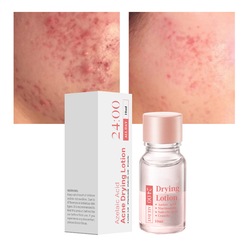 Salicylic Acid Spot Drying Lotion