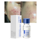 Salicylic Acid Spot Drying Lotion