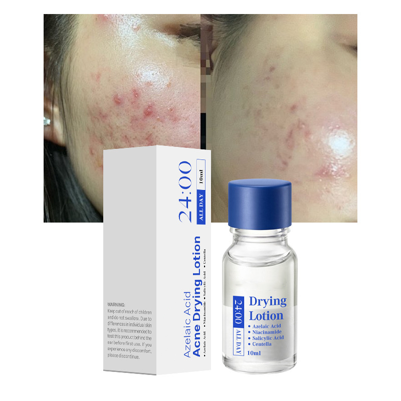 Salicylic Acid Spot Drying Lotion