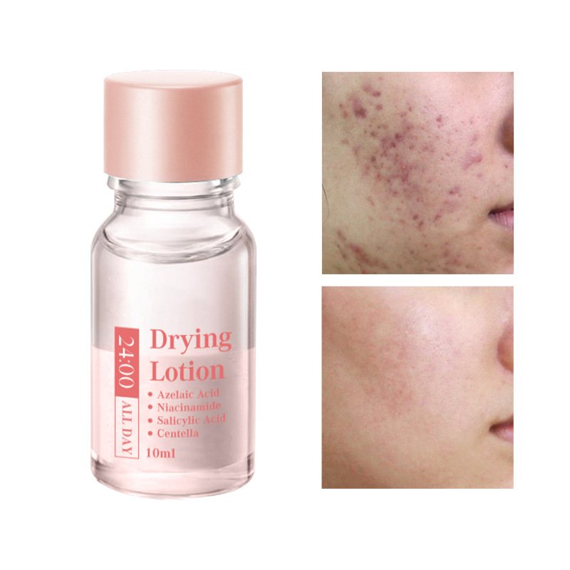 Salicylic Acid Spot Drying Lotion