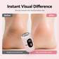 Professional Electric Callus Remover – 20K RPM & Safety Sensor Design