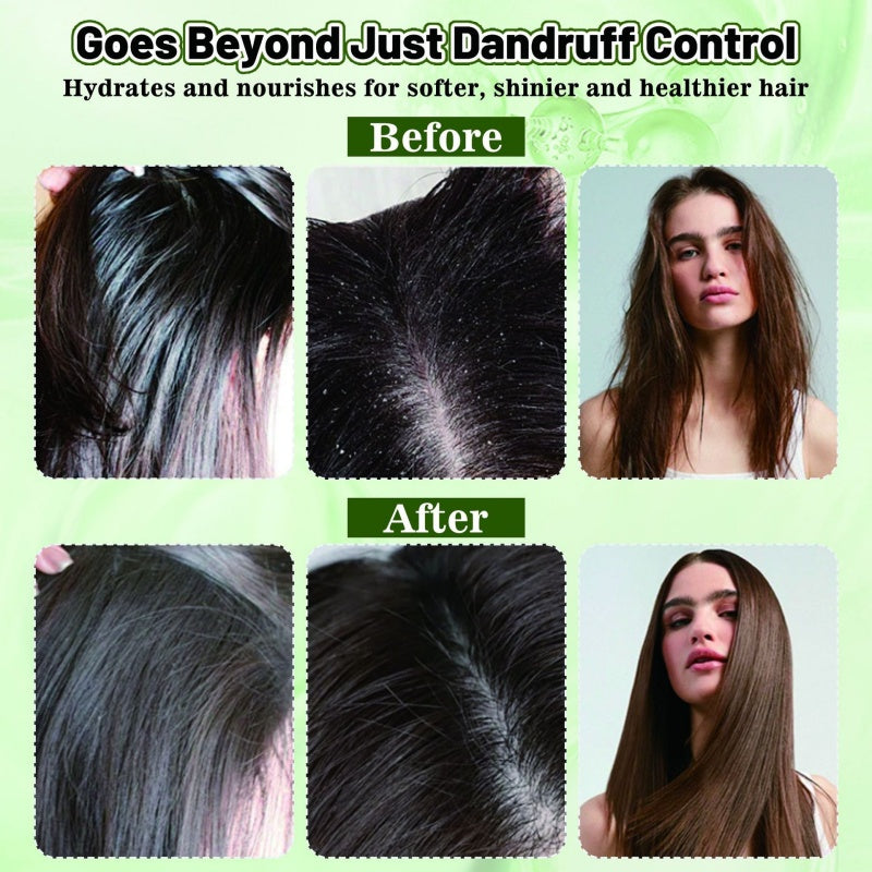 Scalp Mist – Stop Itch, No Flakes